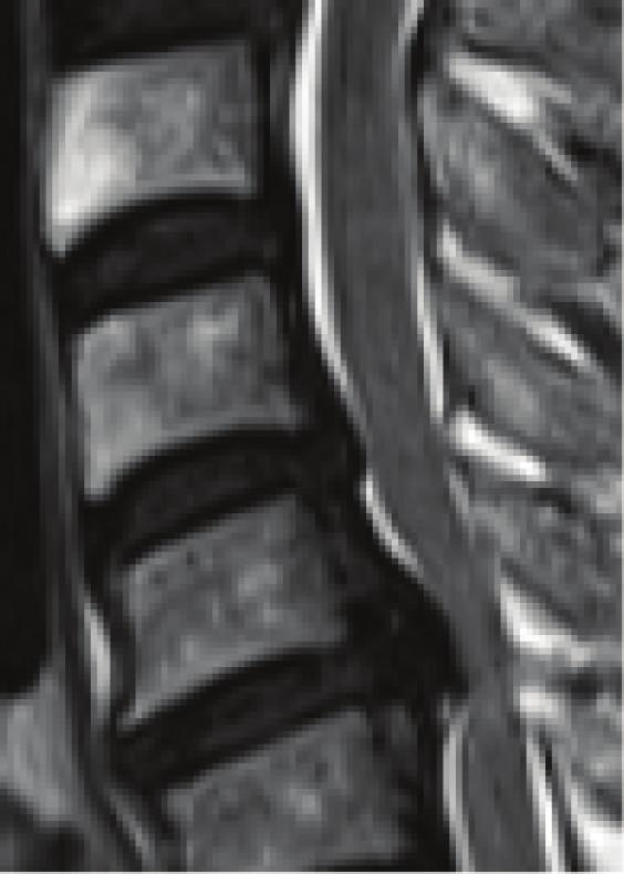 4 Case Reports in Orthopedics C3 C3 C4 C5 C4 C5 (d) Figure 5: Pre- and postoperative magnetic resonance imaging. and : posterior shift of the spinal cord at C4/5 ( ) was 3.8 mm.