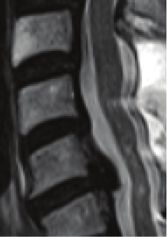 In our case, no high-intensity area was observed at C3/4 on postoperative MRI, and it is hard to explain that the cause of the C5 palsy originated from the spinal cord even if the paralysis had