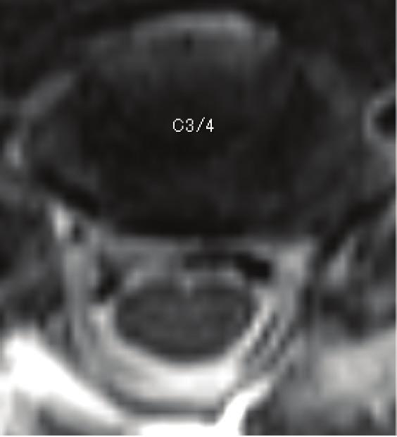 Therefore, bilateral foraminal stenosis at C4/5 and posterior shift of the spinal cord which were thought to have been caused by laminectomy and unintentionally gained lordosis might have resulted in