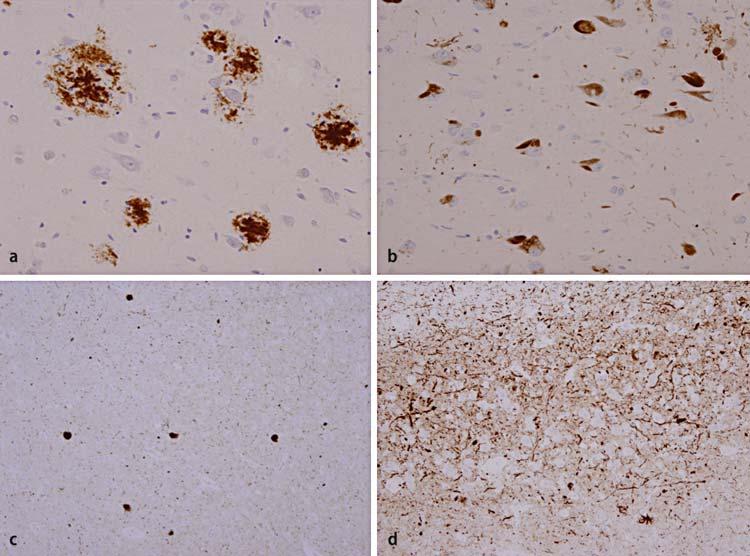 Dementia in PD Pathological findings in a PDD case (a) Amyloid β (A4) senile plaques and (b) tau positive neurofibrillary
