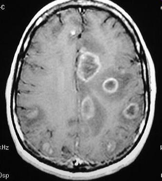 In HIV infected patients prevailed cerebral toxoplasmosis