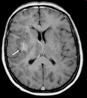 6 Cerebral toxoplasmosis Multiple ring enhancing lesions are