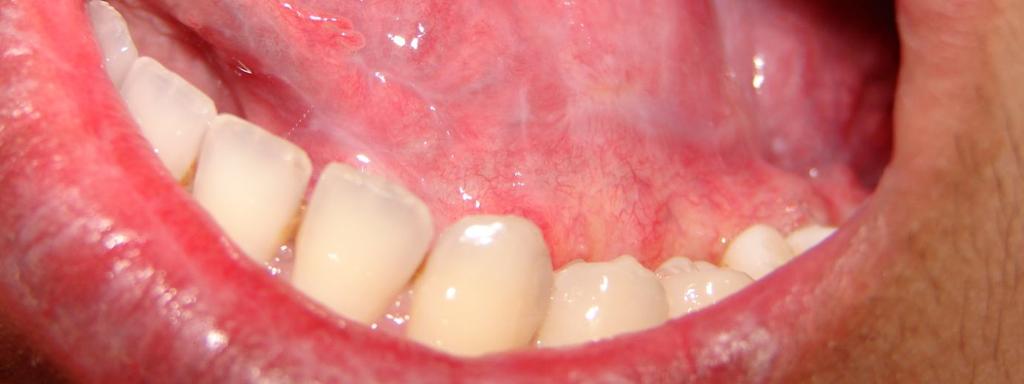 1% tacrolimus as a topical therapy in treating oral lichen planus lesions in a patient with raised SGOT, SGPT levels along with positive Tri Dot for Hepatitis C virus has been portrayed.