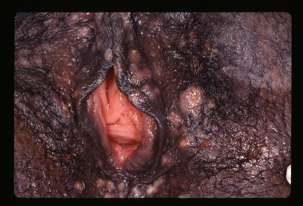 11/13/2012 Case 28 year-old woman Complains of very painful lesions in vulvar area Increasing severity