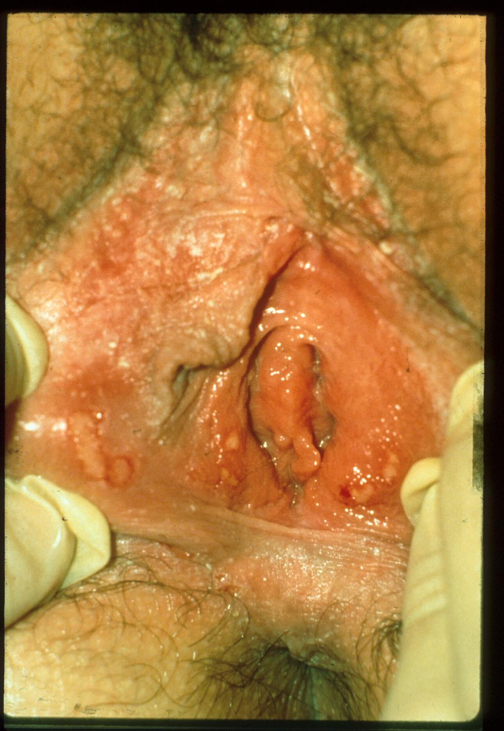 Primary HSV-2 Transmission of Genital HSV Requires contact of viable HSV and abraded skin/mucous.