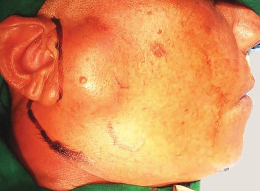 Sushrut Vaidya et al CASE REPORT A 61-year-old female presented with right-sided parotid swelling since 6 months.