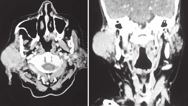 Primary Non-Hodgkin s Lymphoma involving Parotid Gland A B Figs 2A and B: (A) The CT image reflects