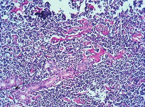 DISCUSSION Malignant lymphoma of the parotid region may arise from an intraparotid lymph node or in the gland itself.