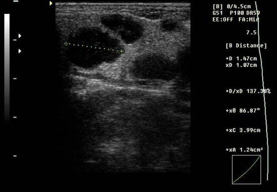 ultrasound aspects resemble to some acute inflammatory lymph nodes.
