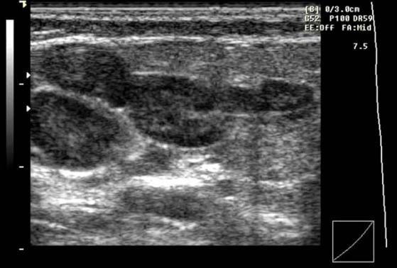*3: Figure 3. Gray scale transverse sonogram of the parotid gland.