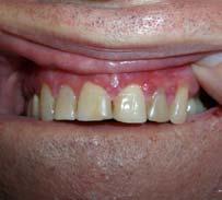 corticosteroid of mid to high potency (2 3 times per day) Custom tray for gingival lesions is an