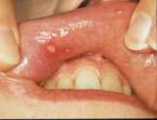Differential Diagnosis of Recurrent/Persistent Oral Ulceration Recurrent Aphthous Stomatitis