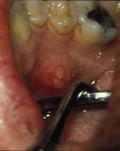 aphthae < 1 cm Major aphthae > 1 cm, deep, heal with scarring < 1 cm, shallow yellow ulcers,