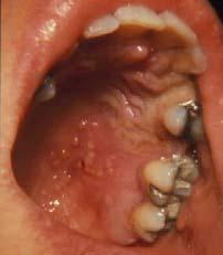 Recurrent intraoral varicella zoster Can mimic a toothache before lesions appear May start as blisters, rapidly rupture to form coalescent shallow ulcers Stops abruptly at the midline Palate a common