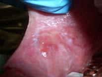 Lichen Planus Bullous form Rare form Large bullae ranging from 4 mm to 2 cm Bullae of brief duration,