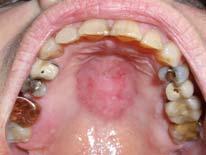 Lichenoid Drug Reaction Increasing prevalence Antibiotics, antihypertensives ACE inhibitors and thiazides, antimalarials, diuretics, gold compounds, NSAIDS, tetracyclines Resembles erosive lichen