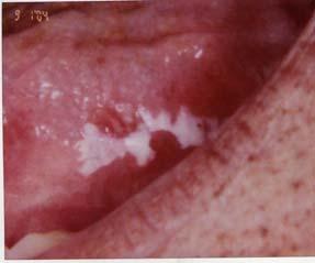 reports of squamous cell carcinoma arising in previously diagnosed oral lp Retrospective review showed that most of these were lesions exhibiting epithelial dysplasia and a lichenoid inflammatory