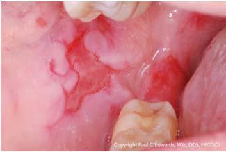 PEMPHIGUS VULGARIS (PV) Most common form of pemphigus Leads to intraepithelial, mucocutaneous blistering Predominantly