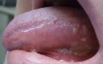 lesions soft palate, gingiva, buccal mucosa Usually bullous stage undetected, presents as eroded, erythema, pain Skin brief blisters, collapses, red crust What causes Pemphigus?