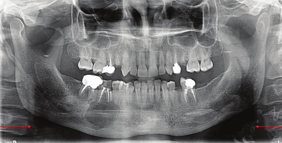 Cse 7 This ptient presented for routine dentl tretment; his pnormic imge showed the presence of multiple symptomtic smll, irregulr in shpe nd size, rdiopque res inferior to the ngle of the mndile t