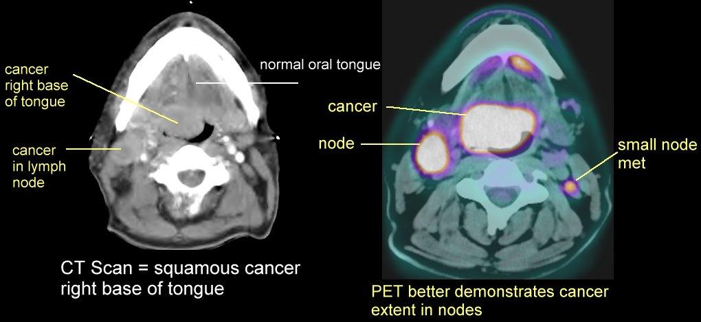 A glucose analogue with the positron-emitting radioactive isotope 18 F- FDG is injected into the patient. Then a PET scanner can form images of the distribution of FDG around the body.