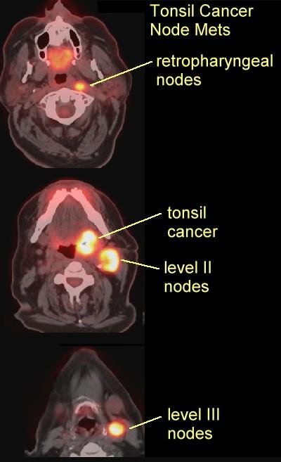 LEVEL OF NODAL DISEASE Image reproduced