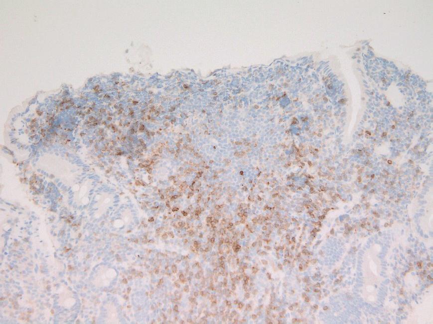 Diﬀuse inﬁltration of follicular lymphoma cells (arrowheads) and neoplastic follicle