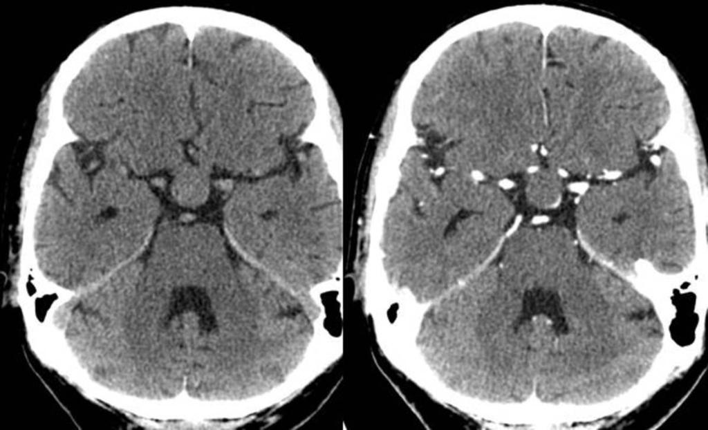 Fig. 2: 64 y/o with acute right eye visual impairment, headache and hyponatremia.