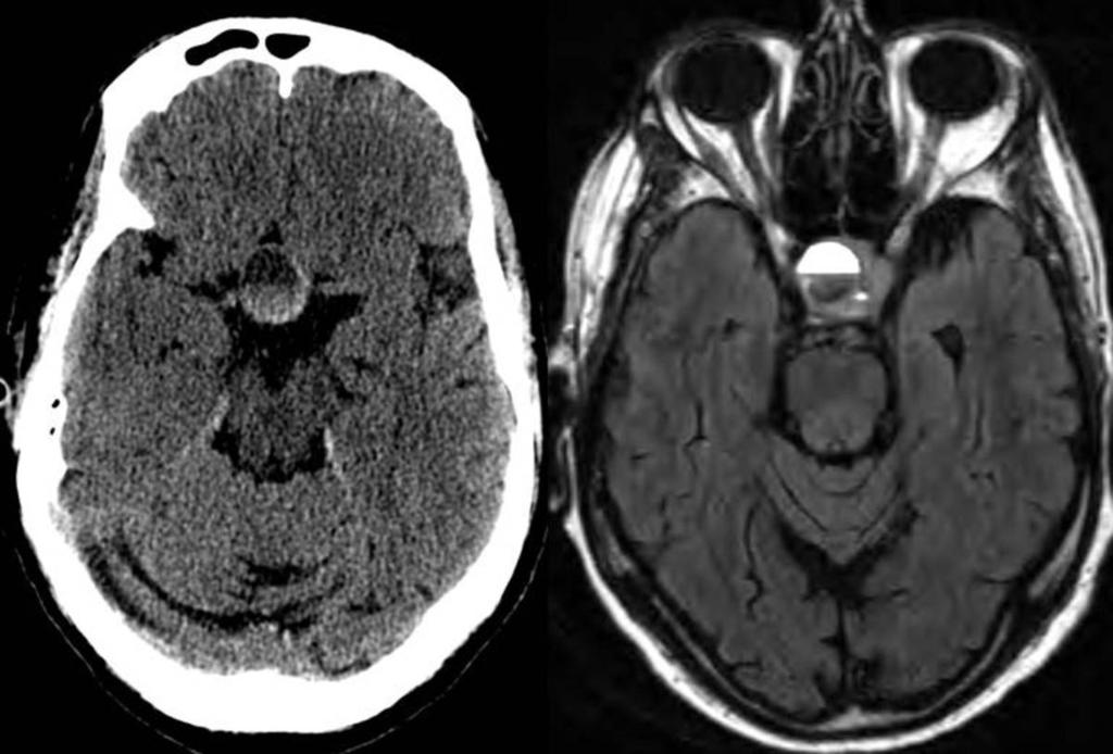 Fig. 4: 64 y/o with acute right eye visual impairment, headache and hyponatremia.