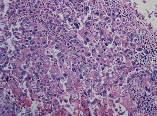 Figure 4: Histopathological Section from the Intramural Mass - 40x (H&E) Pleomorphic Epithelial-Like Tumor