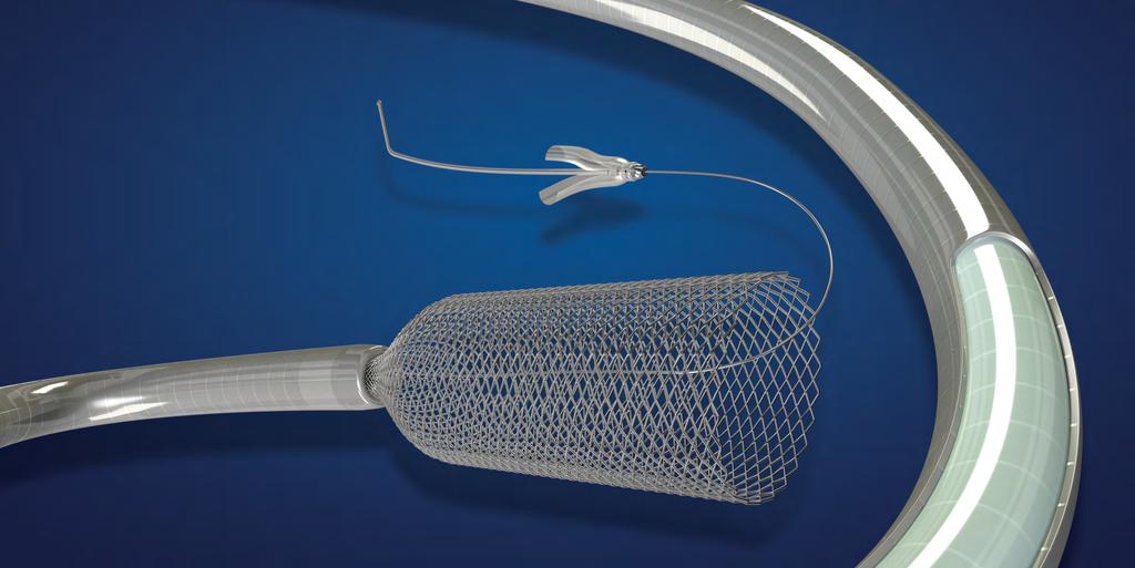 Pipeline Flex Embolization Device The Pipeline Flex embolization device is a braided, multi-alloy cylindrical mesh indicated for the endovascular treatment of adults (age 22 and above) with large or