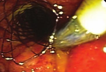 monitoring the endoscopic view (and yellow
