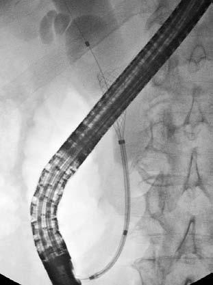 Top end of constrained stent End of exterior tube 3.
