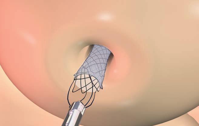 6. REMOVING THE STENT* - In the event of incorrect