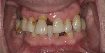 The patient is an employee at a local grocery store, with limited discretionary income. DiagNOsTIC OpINION Periodontal The examination revealed severe bleeding upon probing throughout the mouth.
