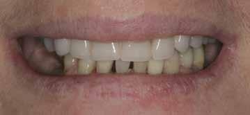 for and gradual transition into implants due to their periodontal risk and poor prognosis.