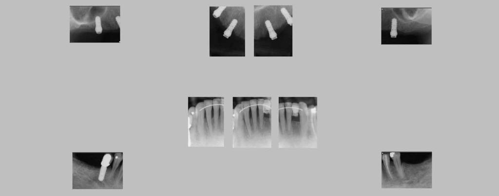 Long term, the patient knew and understood that she has two options: 1. Receive an implant-retained fixed bridge extending from teeth Nos. 23 through 26, with implants in the Nos.