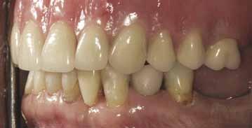 implant retained porcelain-fused-to-metal crown in the space of