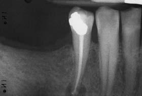 188 Fig 1 Branching accessory canals visible at the apex of a lower second premolar after completion of a root canal treatment.