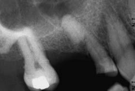 crossinfection between the two. Fig 3a Radiograph showing an upper first molar tooth with severe bone loss and suggestion of furcation involvement.