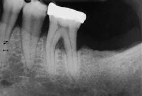 normal limits, using ethyl chloride and an electric pulp tester. Fig 3b Radiograph of an upper first molar tooth with moderate bone loss and suggestion of furcation involvement.