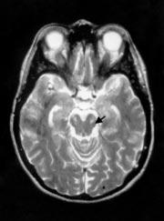 NEUROLOGY IN PRACTICE Abbreviations CBD: corticobasal degeneration EMG: electromyelogram IPD: idiopathic Parkinson s disease MIBG: metaiodobenzylguanadine MRI: magnetic resonance imaging MSA: