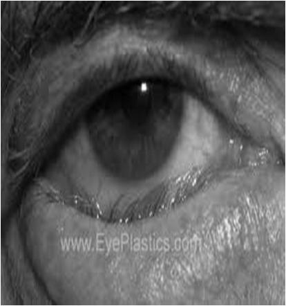 Abnormalities of the eyelids Entropion eyelids and lashes