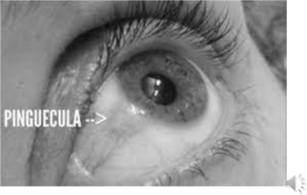 Pinguecula EOM disorders Strabismus Amblyopia