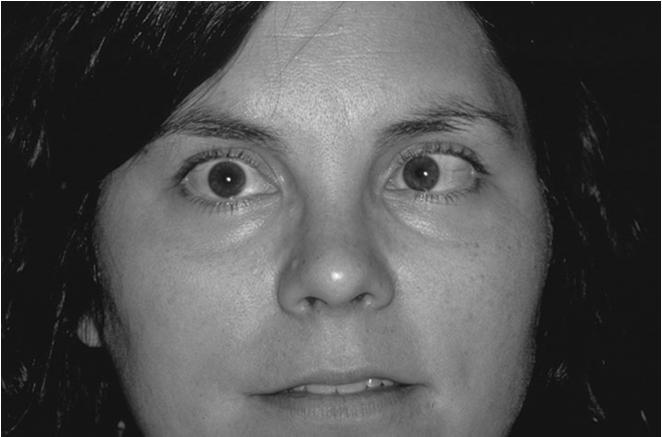 Strabismus Esotropia eye(s) turn to nose Exotropia eye(s) turn outward or temporal Pediatrics: At birth if fixed esotropia or exotropia refer If intermittent