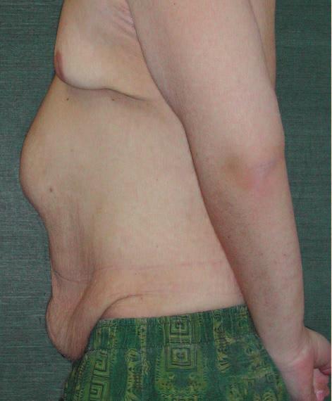 A B C D Figure 11. A, C, Preoperative views of a 17-year-old man with a large ventral hernia and a 162-lb weight loss. B, D, Postoperative views 2.5 months after fleur-de-lis abdominoplasty.