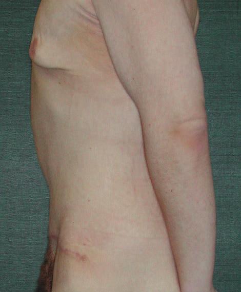 23,24,33,34 In this series, 1 patient had a wound dehiscence along the flank 16 days postoperatively, and another had a 1-cm distal flap loss in the gluteal crease that healed secondarily.