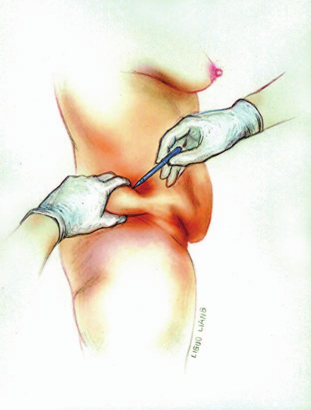 Figure 4. A pinch test is used along the flank rolls and marked for excision if a circumferential procedure is performed. Figure 5.