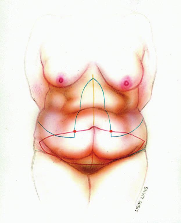 Figure 6. A gull-wing incision is designed in the gluteal crease. It is important to keep the incision line low.