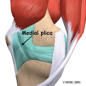 Patellofemoral Pain Syndrome (PFPS) Imbalance between the medial and lateral quadriceps group Abnormal patella glide with motion a.k.a. lateral